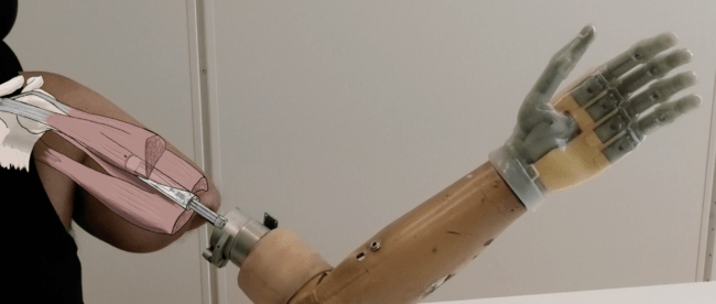 WIRED FOR MOTION: INNOVATIVE NERVE REWIRING LETS AMPUTEES CONTROL BIONIC HAND NATURALLY